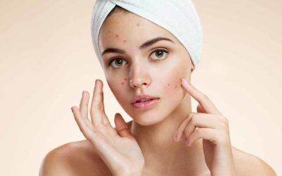 Acne giovanile rimedi naturali