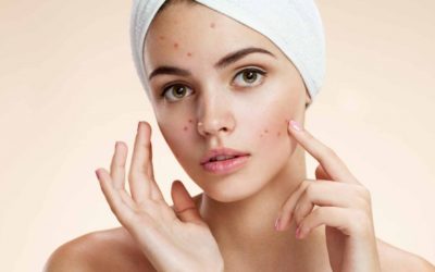 How to treat acne: natural remedies